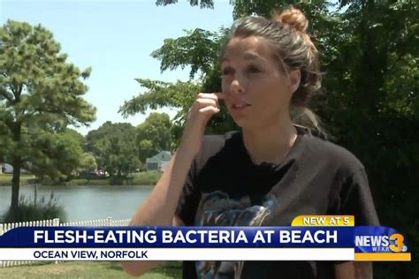 Woman Gets Flesh Eating Bacteria That ‘spreads Really Quickly After Swimming At Virginia Beach