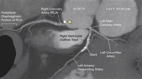 Noninvasive Coronary Angiography With Multislice Computed Tomography