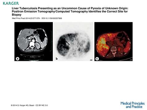 Liver Tuberculosis Presenting As An Uncommon Cause Of Pyrexia Of