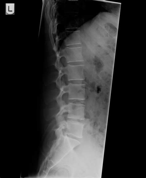 Normal Lumbosacral X Ray Lateral Lumbar Radiographs Left