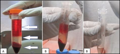 A Bone Marrow Blood Separation Into Plasma Buffy Coat And Red Blood