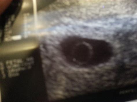 6 Weeks 6 Days Gestational Sac An Yolk Sac No Fetus Babycenter
