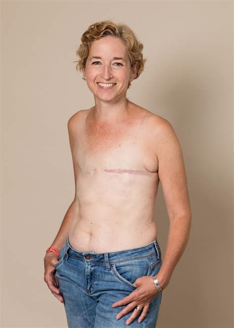 Brave Mum Poses Topless To Show Mastectomy Scars After Beating Breast