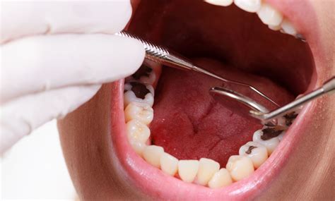 Como Tratar As Caries