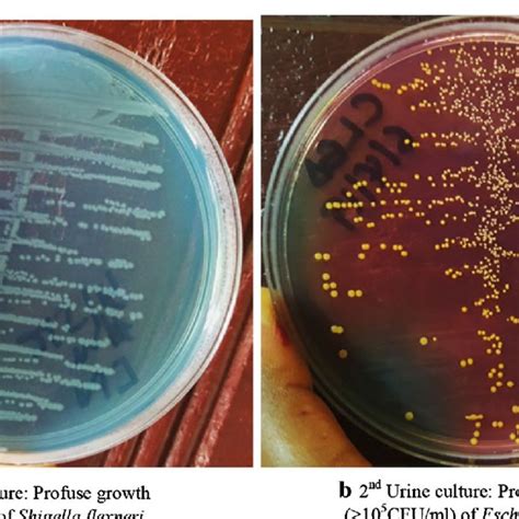 Bacterial Growth On Cled Agar After 24 H Of Incubation Of Patient Urine