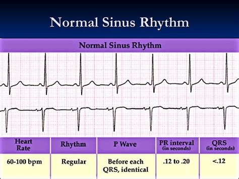 Ppt Ecg 101 Qrs Axis Determination Powerpoint Presentation Free Free