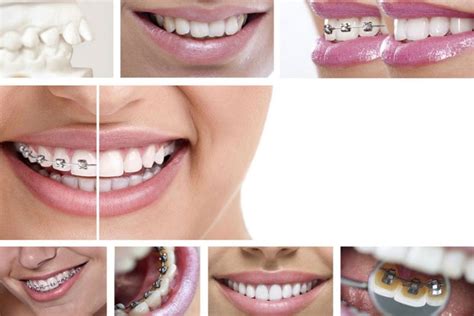 Getting Braces What You Should Know Greater Hartford Ortho