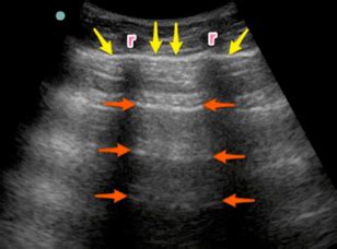 Pv Card Focused Lung Ultrasound