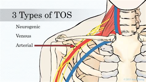Nerve Block Treatment For Thoracic Outlet Syndrome Tos Johns