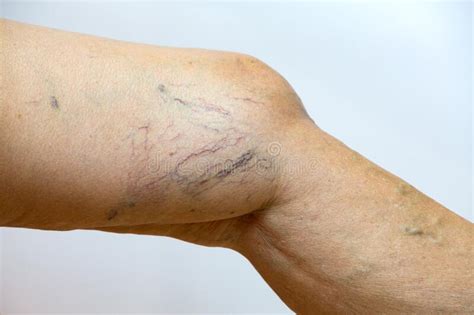 Varicose Veins On A Leg In Senior Women Close Up And Macro Shot Selective Focus Asian Body Skin