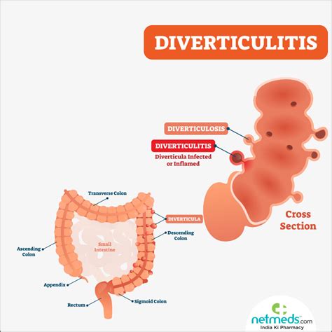 Diverticulosis And Diverticulitis Guide Causes Symptoms And Treatment