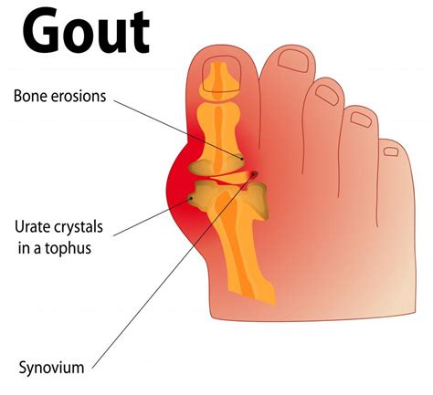 What Is The Connection Between Gout And Uric Acid