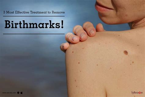 3 Most Effective Treatment To Remove Birthmarks By Dr Richa Thakur