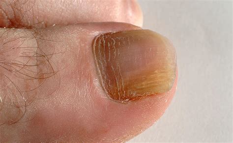 It is found that about 3 to 5 percent of the us population is affected by this toenail fungus. How To Prevent Nail Fungus? - Complete Person
