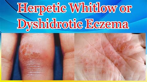 Herpetic Whitlow Or Dyshidrotic Eczema Youtube