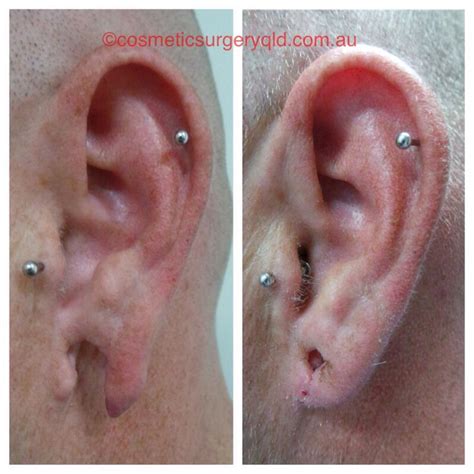 Pin On Repair Stretched And Torn Earlobes