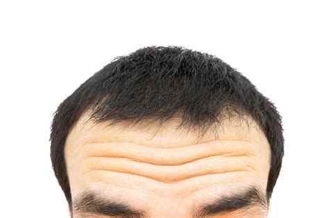 Forehead Wrinkles An Early Sign Of Cardiovascular Disease