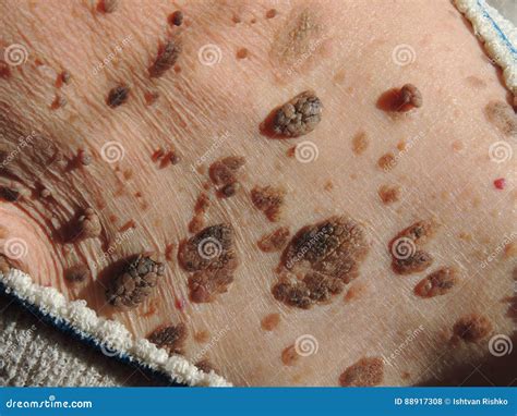 Many Mole On The Skin Of Elderly Woman Stock Photo Image Of Close