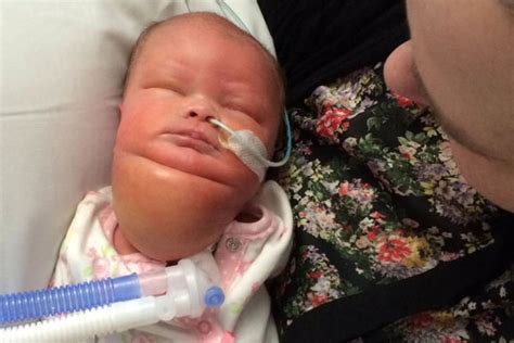 Baby Who Was Born With A Massive Neck Tumor Celebrates First New Year