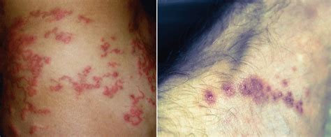 Foreign Travelers Cutaneous Parasitic Infections From Abroad Emra