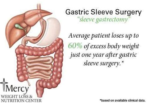 Pin On Gastric Sleeve