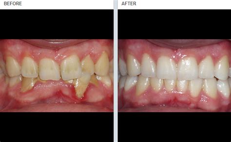 Most patients want to know how to fix an overbite at home, or even how to fix an overbite naturally. Beach Smile Dental | Your trusted dental clinic | Bay ...
