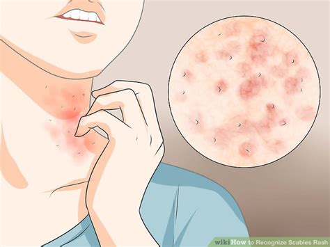 How To Recognize Scabies Rash With Pictures Wikihow