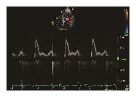 Echocardiographic Images From A Patient With Restrictive Download