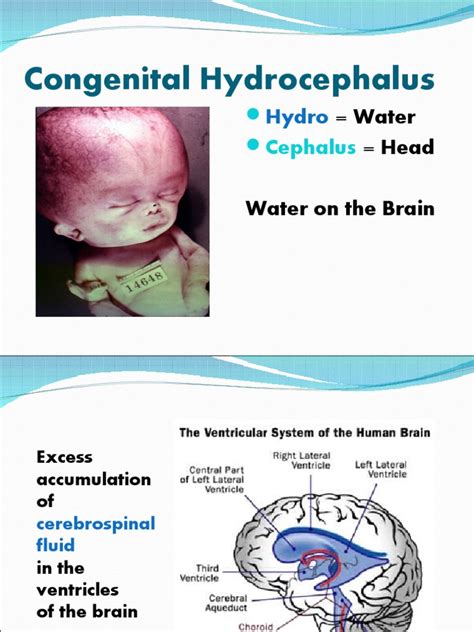 Congenital Hydrocephalus Porn Sex Picture