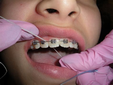 Maybe you would like to learn more about one of these? How To Floss With Wire Behind Teeth - TeethWalls