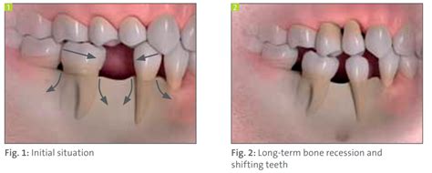 Complete Guide To Dental Implants Best Way To Replace Missing Teeth