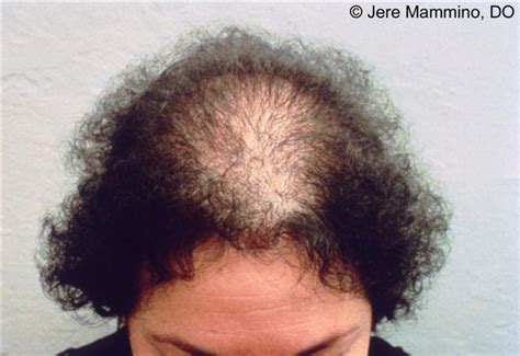 Female Pattern Hair Loss American Osteopathic College Of Dermatology