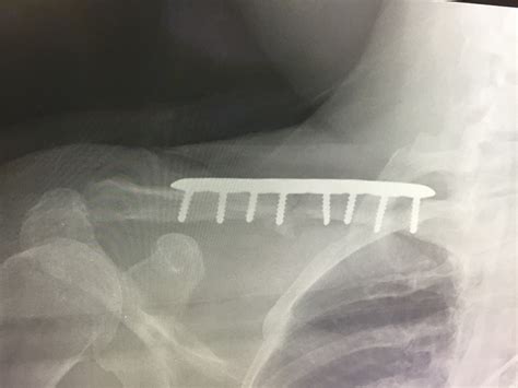Superior Lateral Clavicle Plate Ortho Providers