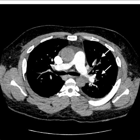 Computed Tomography Ct Pulmonary Angiogram Shows Distal Pulmonary
