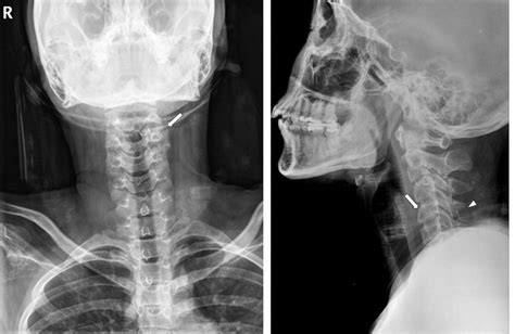 Radiographic Anatomy Of The Skeleton Cervical Spine Anteroposterior