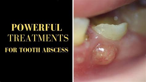 Tooth Abscess Treatment Golden Technique To Cure Tooth Abscess