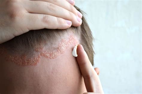 La Dermatitis Seborreica Es Una Enfermedad Común Entre La Población