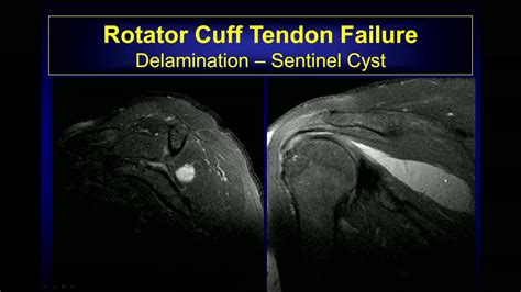 Right Rotator Cuff Tear And Impingement Lupon Gov Ph