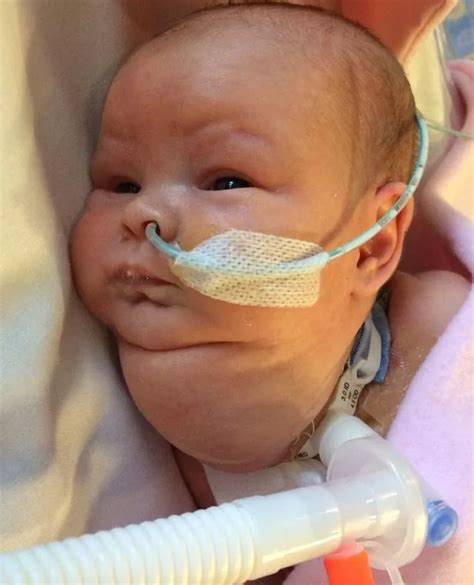 Amazing Stories Around The World Miracle Baby Survived Cancer While