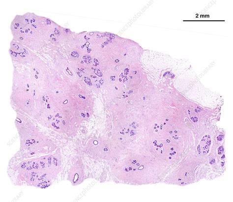 Human Breast Light Micrograph Stock Image C Science