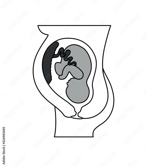Placental Previa Fetus In Uterus During Pregnancy Pregnancy Women