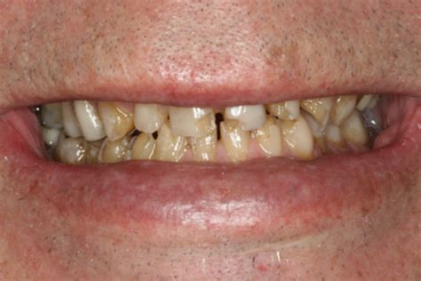 Restorative Management Of Full Mouth Worn Dentition Chatswood Dental