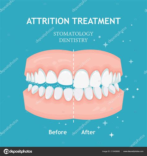 Attrition Treatment Vector Stomatology Dentistry Concept — Stock Vector