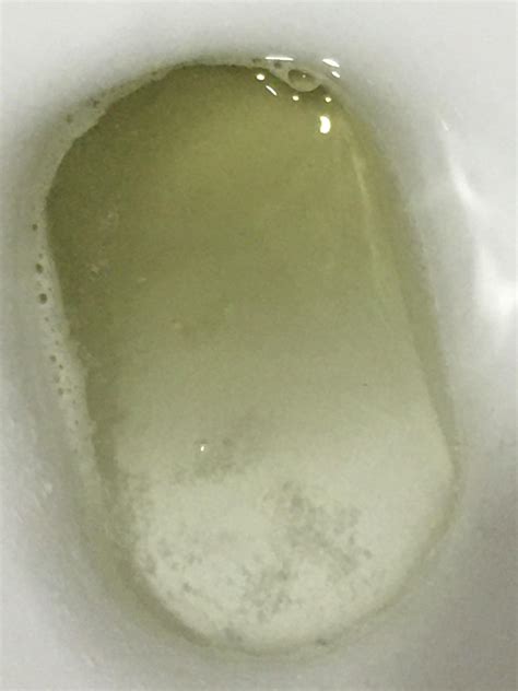 Is This Foamy Urine I Had It For A Few Weeks Now But Had No Other Symptoms R Kidneydisease