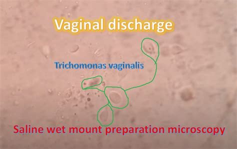 Trichomoniasis Introduction Symptoms Risk Factors Lab Diagnosis