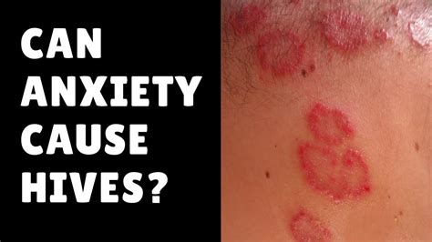 Can Anxiety Cause Hives Relieve Symptoms Fast Using
