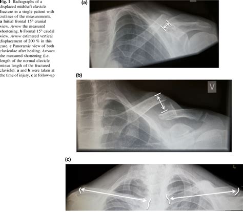 Radiographs Of A Displaced Midshaft Clavicle Fracture In A Single