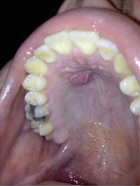 Tiny Bumps On Mouth Roof Sores On Roof Of Mouth Find The Causes Of