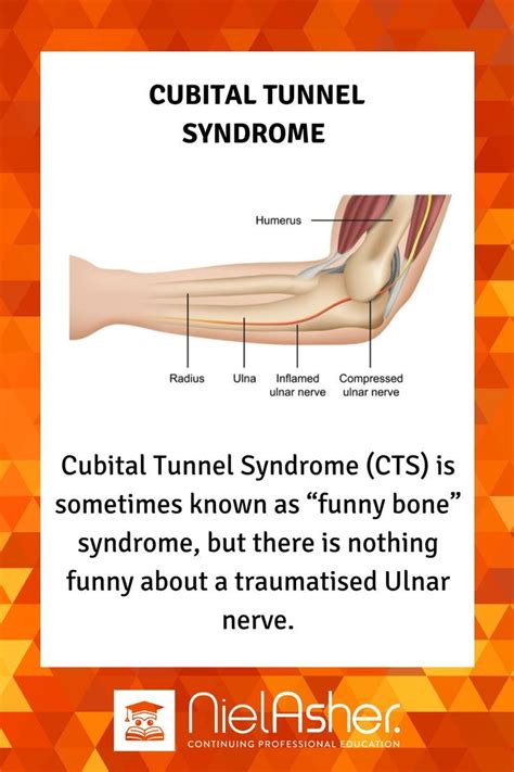 Treating Cubital Tunnel Syndrome Cubital Tunnel Syndrome Syndrome