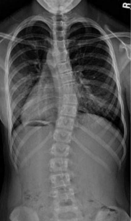 Adolescent Idiopathic Scoliosis Spine Orthobullets
